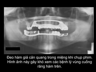 Đeo hàm giả cản quang trong miệng khi chụp phim.
Hình ảnh này gây khó xem các bệnh lý vùng cuống
răng hàm trên.
 