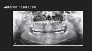 Anterior nasal spine
 