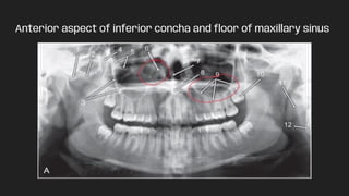 Anterior aspect of inferior concha and ﬂoor of maxillary sinus
 