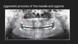 Zygomatic process of the maxilla and zygoma
 