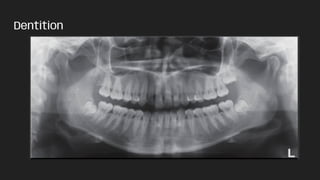 Dentition
 