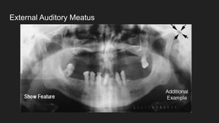 External Auditory Meatus
 