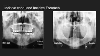 Incisive canal and Incisive Foramen
 