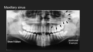 Maxillary sinus
 
