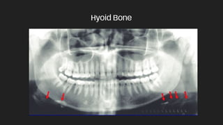 Hyoid Bone
 
