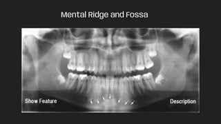 Mental Ridge and Fossa
 