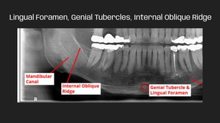 Lingual Foramen, Genial Tubercles, Internal Oblique Ridge
 