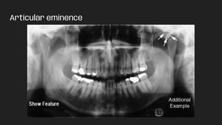 Articular eminence
 