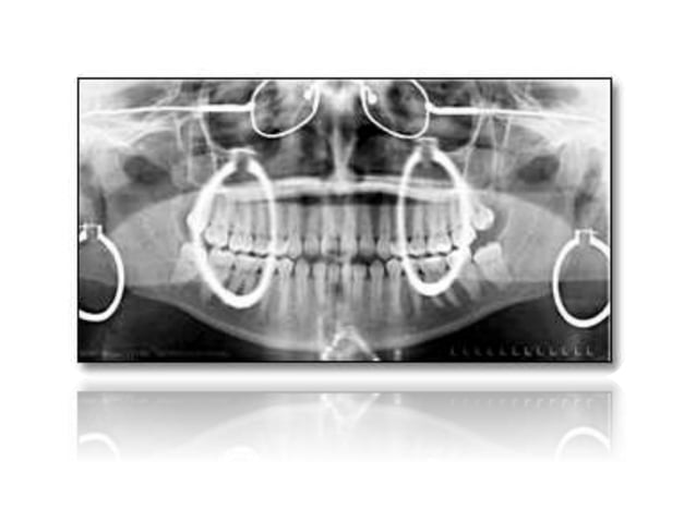 Panoramic radiography | PPTX | Dental Health | Diseases and Conditions