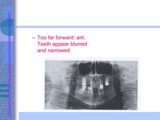 – Too far forward: ant.
Teeth appear blurred
and narrowed
 
