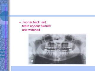 – Too far back: ant.
teeth appear blurred
and widened
 