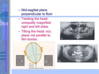 – Mid-sagittal plane
perpendicular to floor
– Twisting the head:
unequally magnified
right and left sides
– Tilting the head: occ.
plane not parallel to
film border.
 