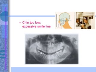 – Chin too low:
excessive smile line
 