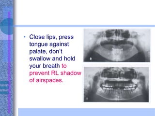 • Close lips, press
tongue against
palate, don’t
swallow and hold
your breath to
prevent RL shadow
of airspaces.
 