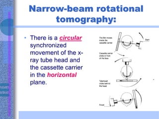Narrow-beam rotational
tomography:
• There is a circular
synchronized
movement of the x-
ray tube head and
the cassette carrier
in the horizontal
plane.
 