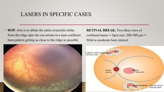 BASICS OF PAN RETINAL, SECTOR AND FOCAL RETINAL LASER PHOTOCOAGULATION.pptx