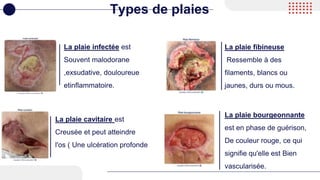 La plaie infectée est
Souvent malodorane
,exsudative, douloureue
etinflammatoire.
Types de plaies
La plaie fibineuse
Ressemble à des
filaments, blancs ou
jaunes, durs ou mous.
La plaie cavitaire est
Creusée et peut atteindre
l'os ( Une ulcération profonde
La plaie bourgeonnante
est en phase de guérison,
De couleur rouge, ce qui
signifie qu'elle est Bien
vascularisée.
 
