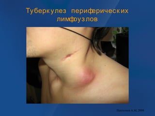 Туберк улез периферическ их
лимфоузлов
Пантелеев А.М, 2008
 