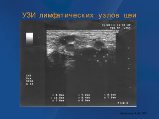 УЗИ лимфатическ их узлов шеи
Пантелеев А.М, 2011
 