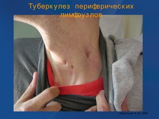 Туберк улез периферическ их
лимфоузлов
Пантелеев А.М, 2008
 