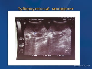 Туберк улезный мезаденит
Пантелеев А.М, 2008
 
