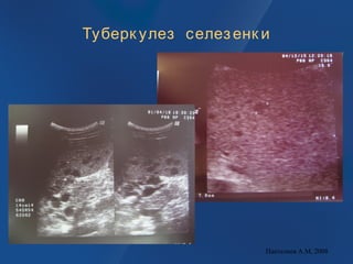 Туберк улез селезенк и
Пантелеев А.М, 2008
 