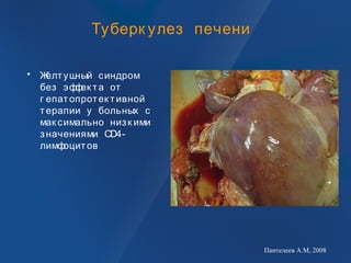 Туберк улез печени
• Желтушный синдром
без эффек та от
г епатопротек тивной
терапии у больных с
мак симально низк ими
значениями CD4-
лимфоцитов
Пантелеев А.М, 2008
 