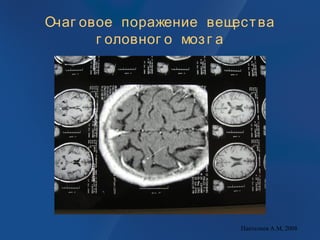 Очаг овое поражение вещества
г оловног о мозг а
Пантелеев А.М, 2008
 