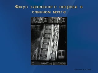 Фок ус к азеозног о нек роза в
спинном мозг е
Пантелеев А.М, 2008
 