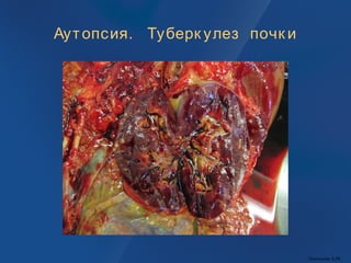 Аутопсия. Туберк улез почк и
Пантелеев А.М.
 