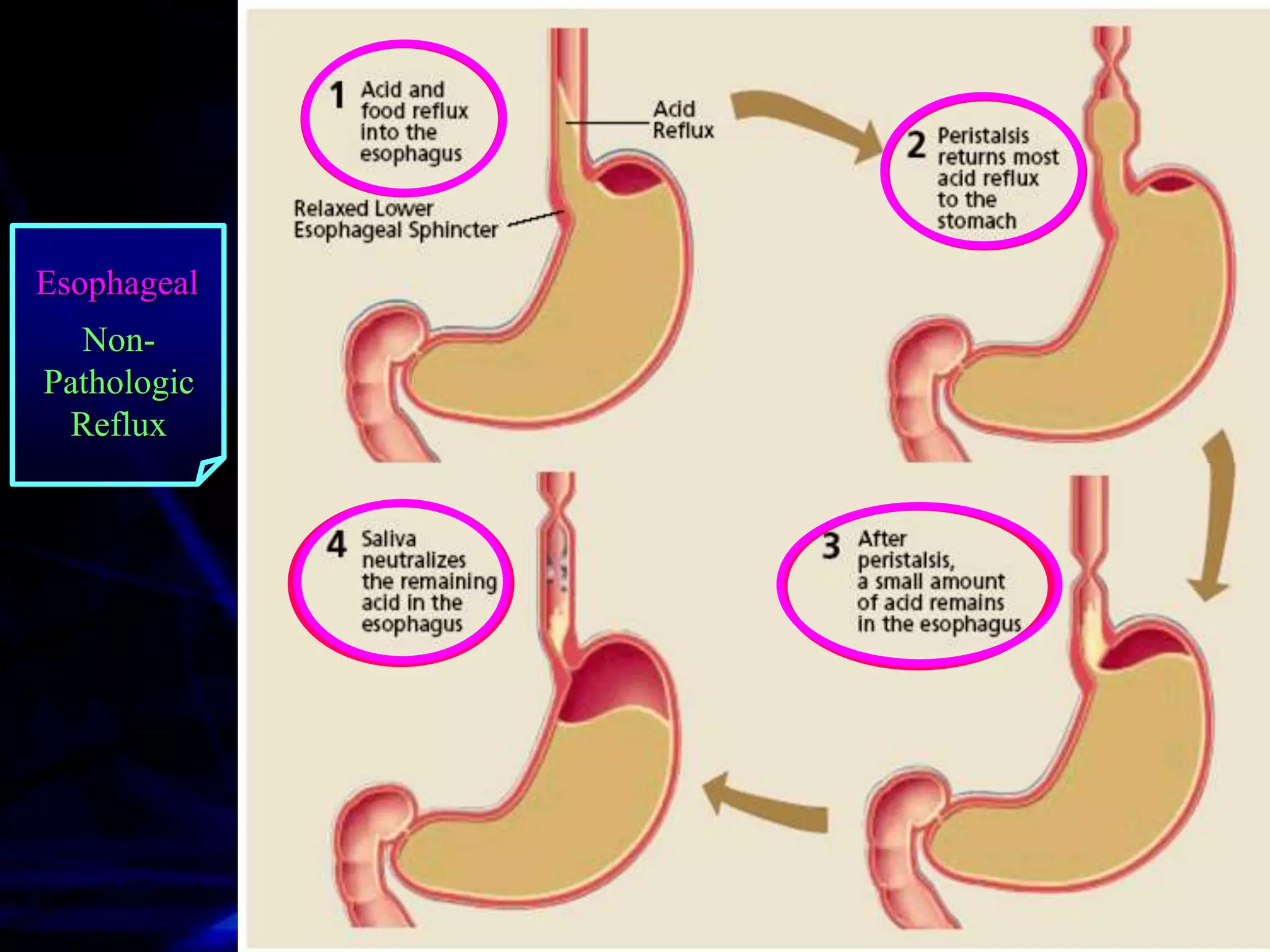 Esophageal
  Non-
Pathologic
 Reflux
 