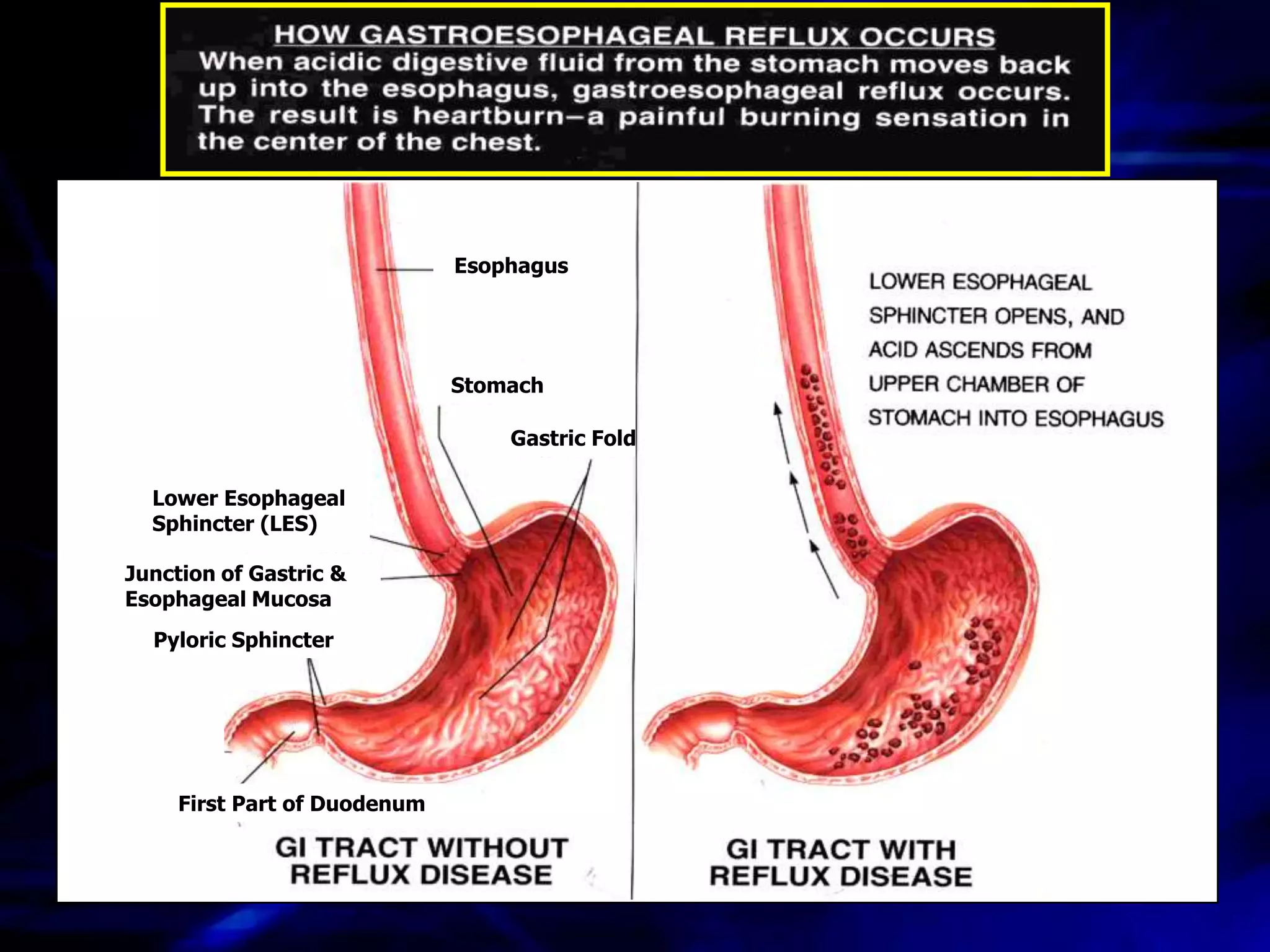 Esophagus




                              Stomach

                                  Gastric Folds

  Lower Esophageal
  Sphincter (LES)

Junction of Gastric &
Esophageal Mucosa
  Pyloric Sphincter




     First Part of Duodenum
 