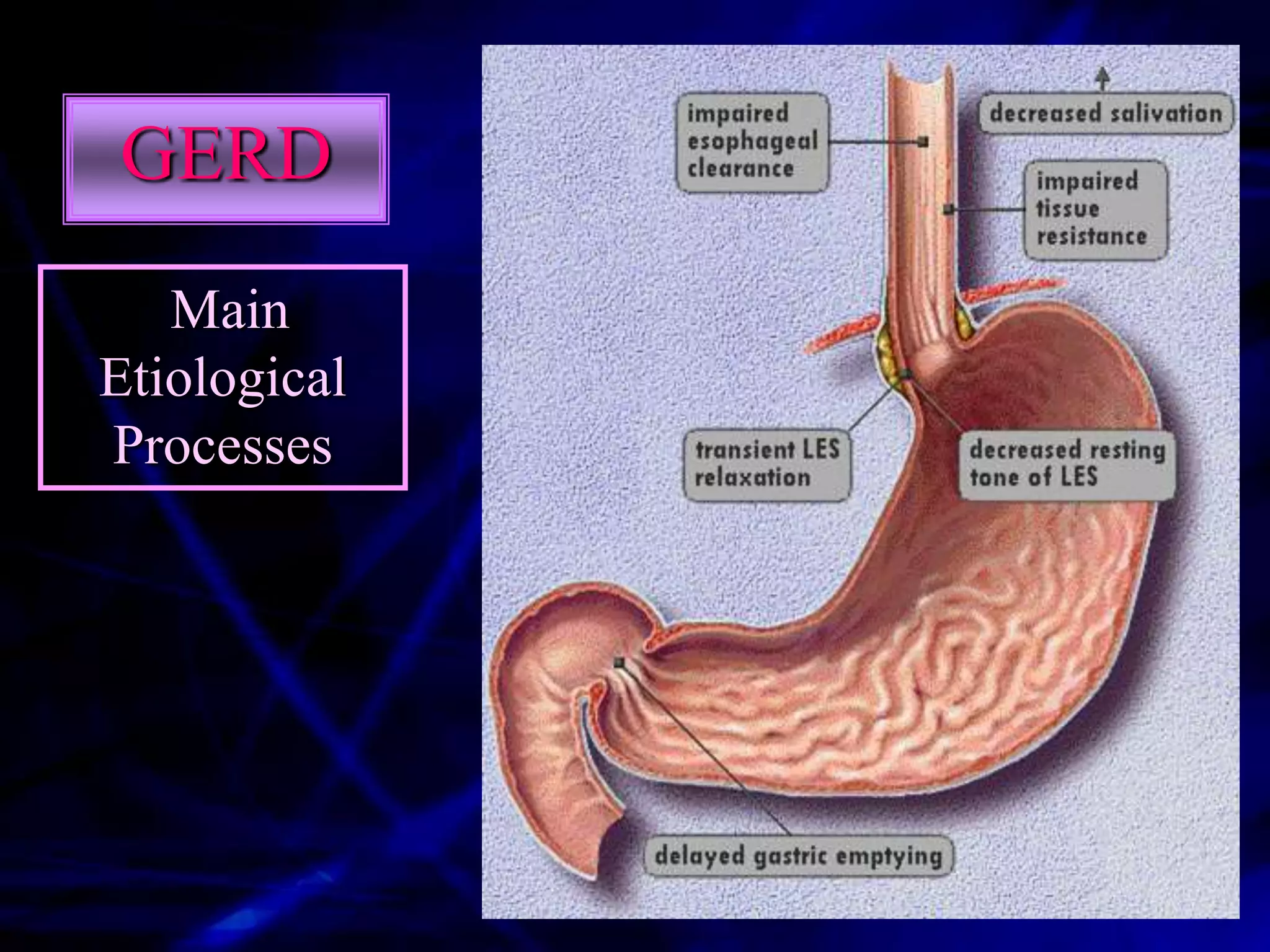 GERD
   Main
Etiological
Processes
 