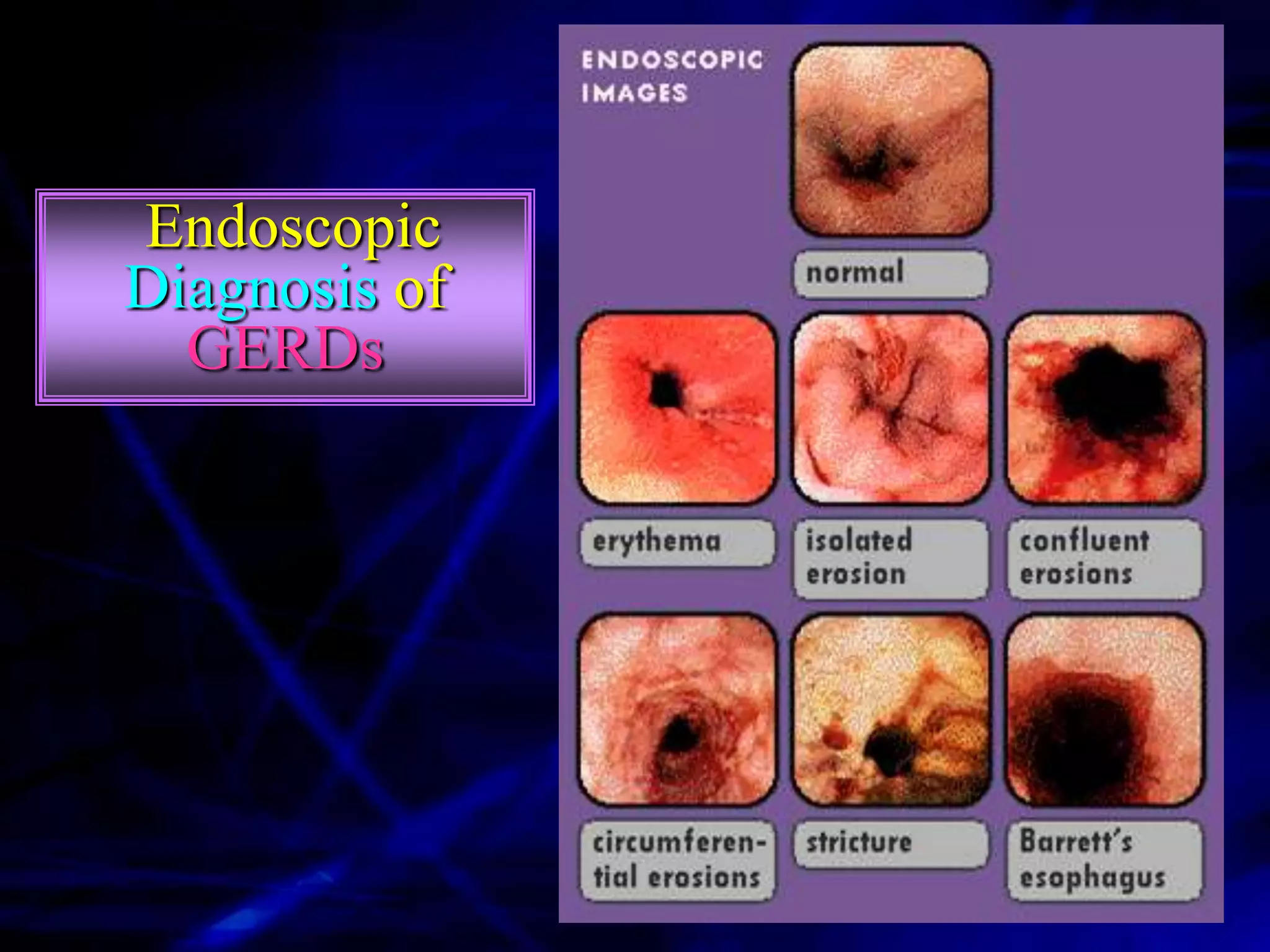Endoscopic
Diagnosis of
  GERDs
 