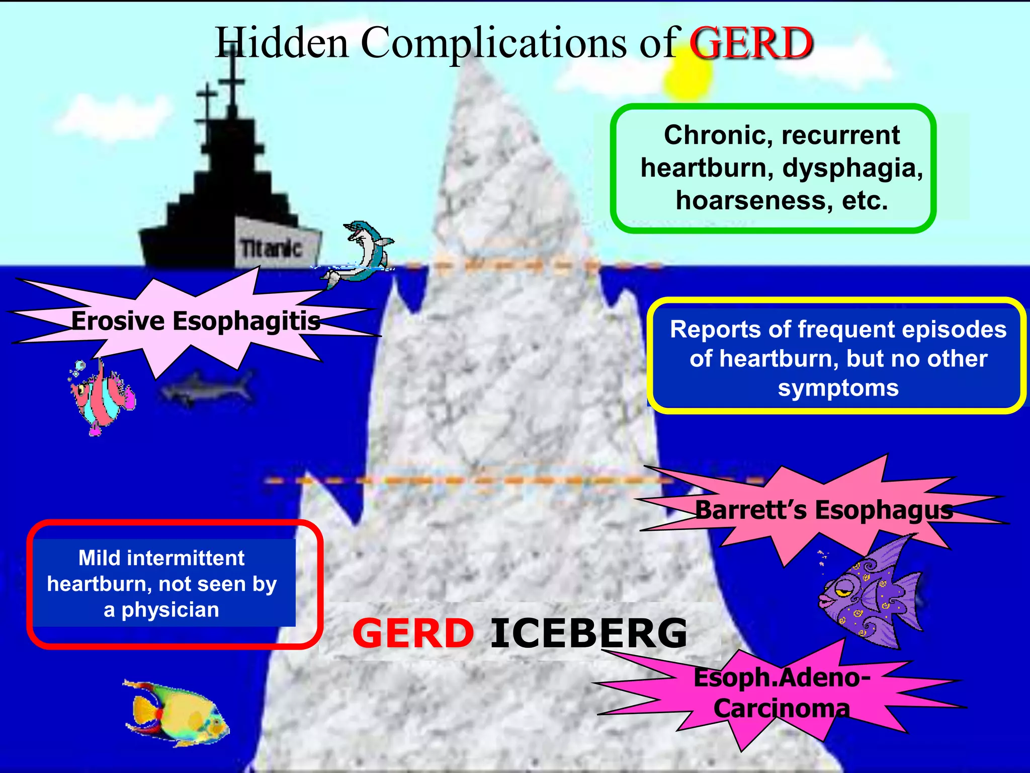 Hidden Complications of GERD
                                    Chronic, recurrent
                                   heartburn, dysphagia,
                                     hoarseness, etc.



  Erosive Esophagitis                Reports of frequent episodes
                                      of heartburn, but no other
                                              symptoms




                                        Barrett’s Esophagus
   Mild intermittent
heartburn, not seen by
     a physician
                         GERD ICEBERG
                                        Esoph.Adeno-
                                         Carcinoma
 
