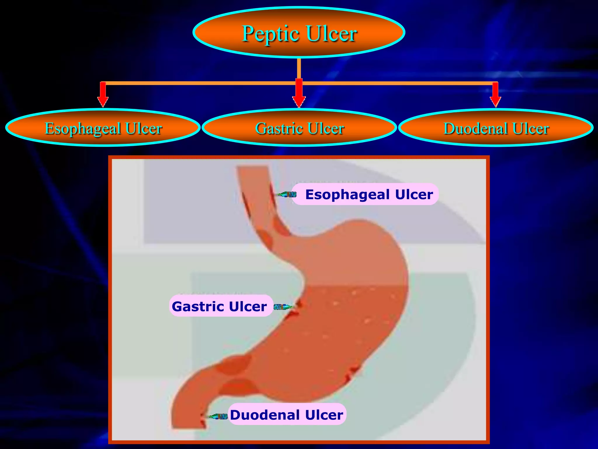 Peptic Ulcer


Esophageal Ulcer              Gastric Ulcer             Duodenal Ulcer


                                     Esophageal Ulcer




                   Gastric Ulcer




                          Duodenal Ulcer
 