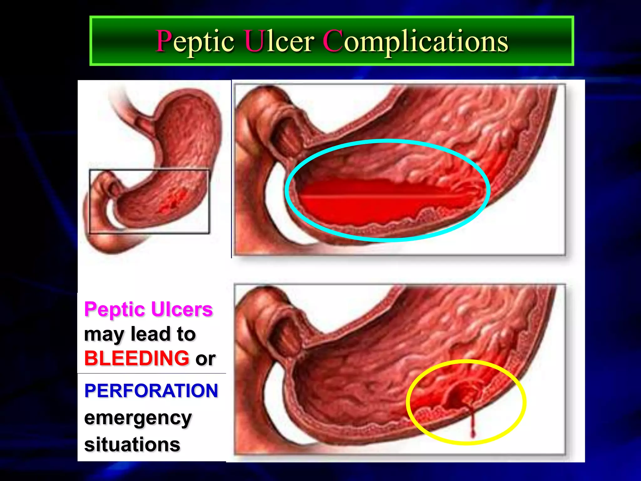 Peptic Ulcer Complications




Peptic Ulcers
may lead to
BLEEDING or
PERFORATION
emergency
situations
 