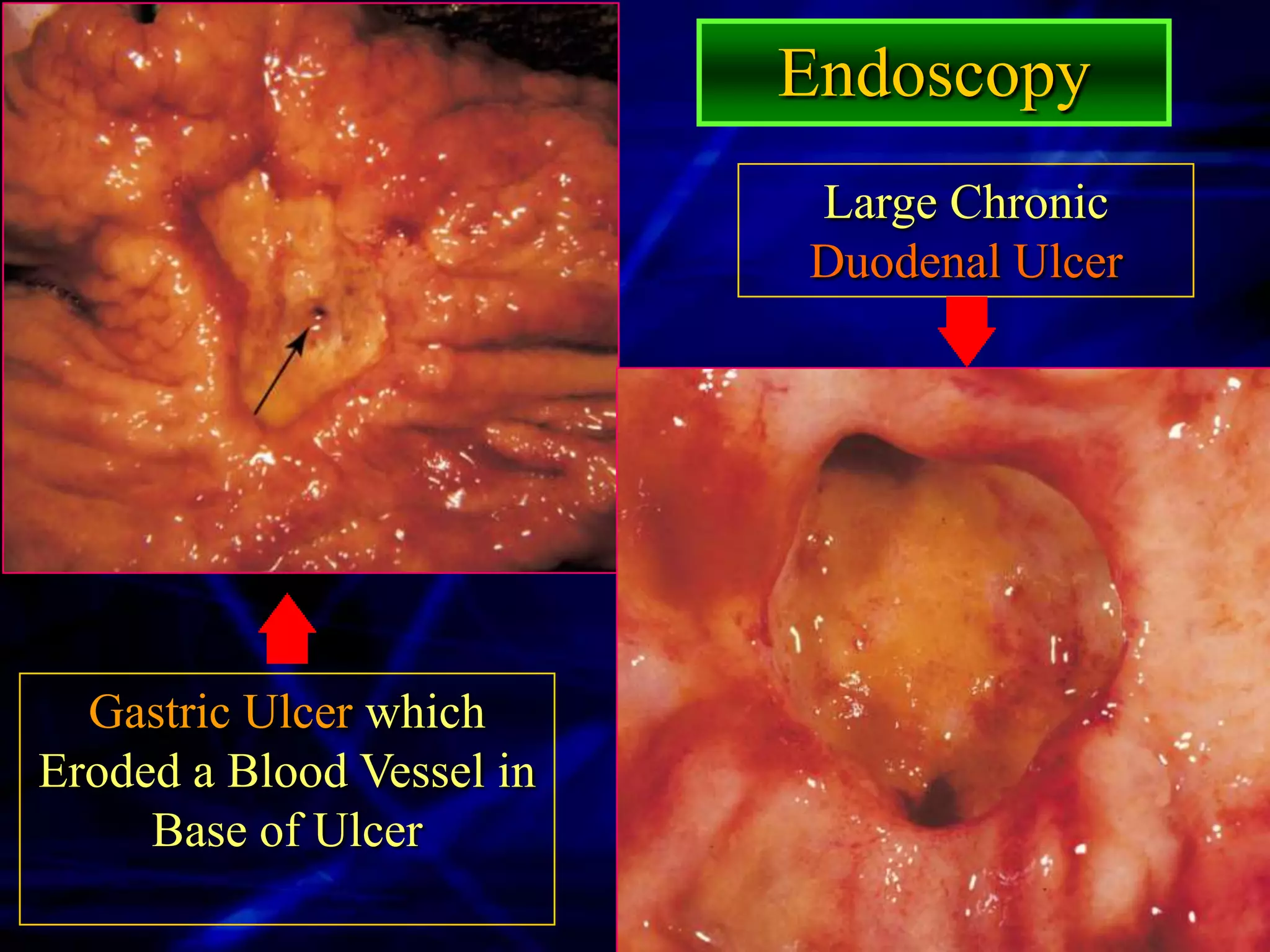 Endoscopy
                           Large Chronic
                           Duodenal Ulcer




  Gastric Ulcer which
Eroded a Blood Vessel in
     Base of Ulcer
 
