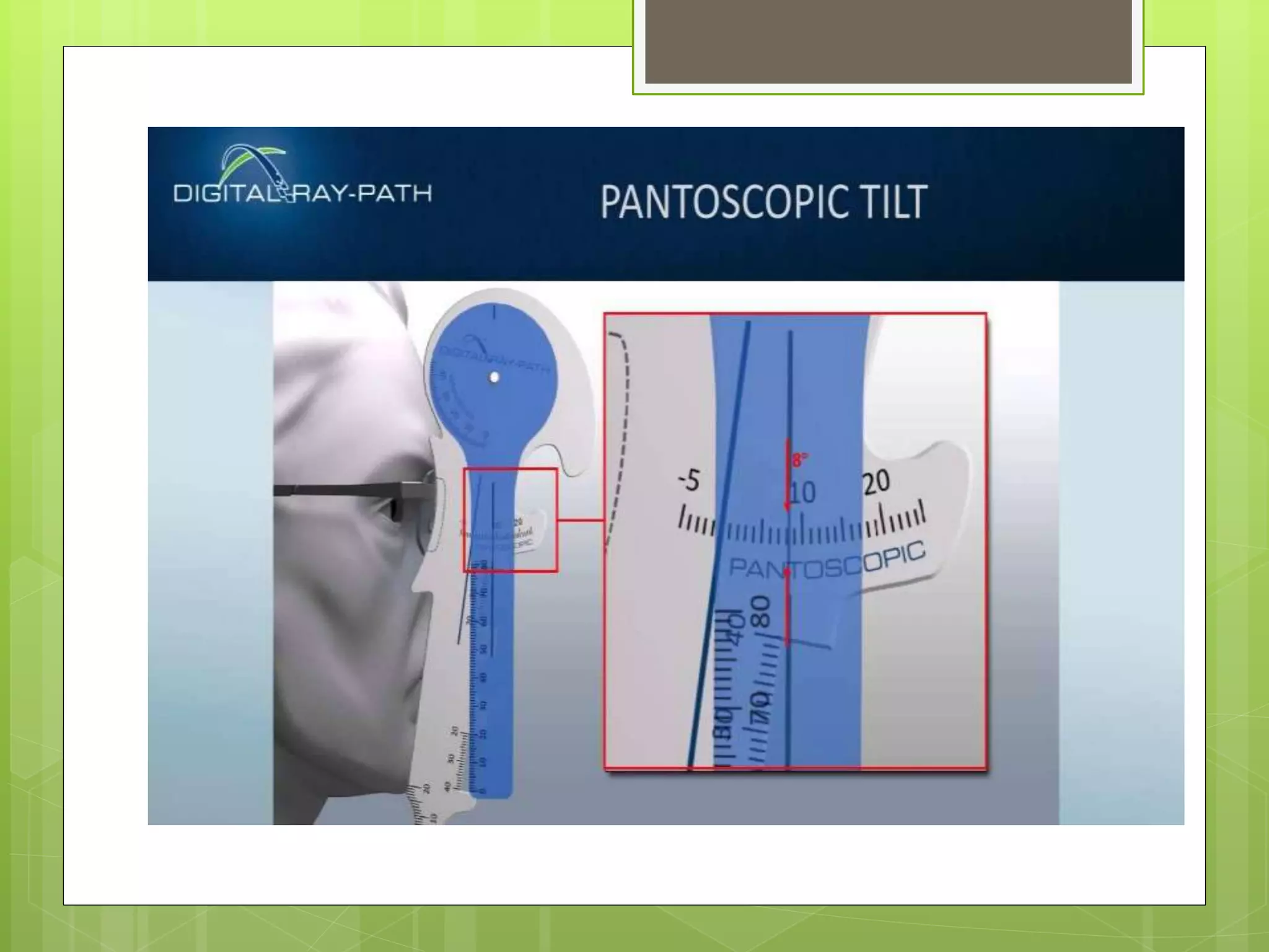 Pantoscopic tilt PPT