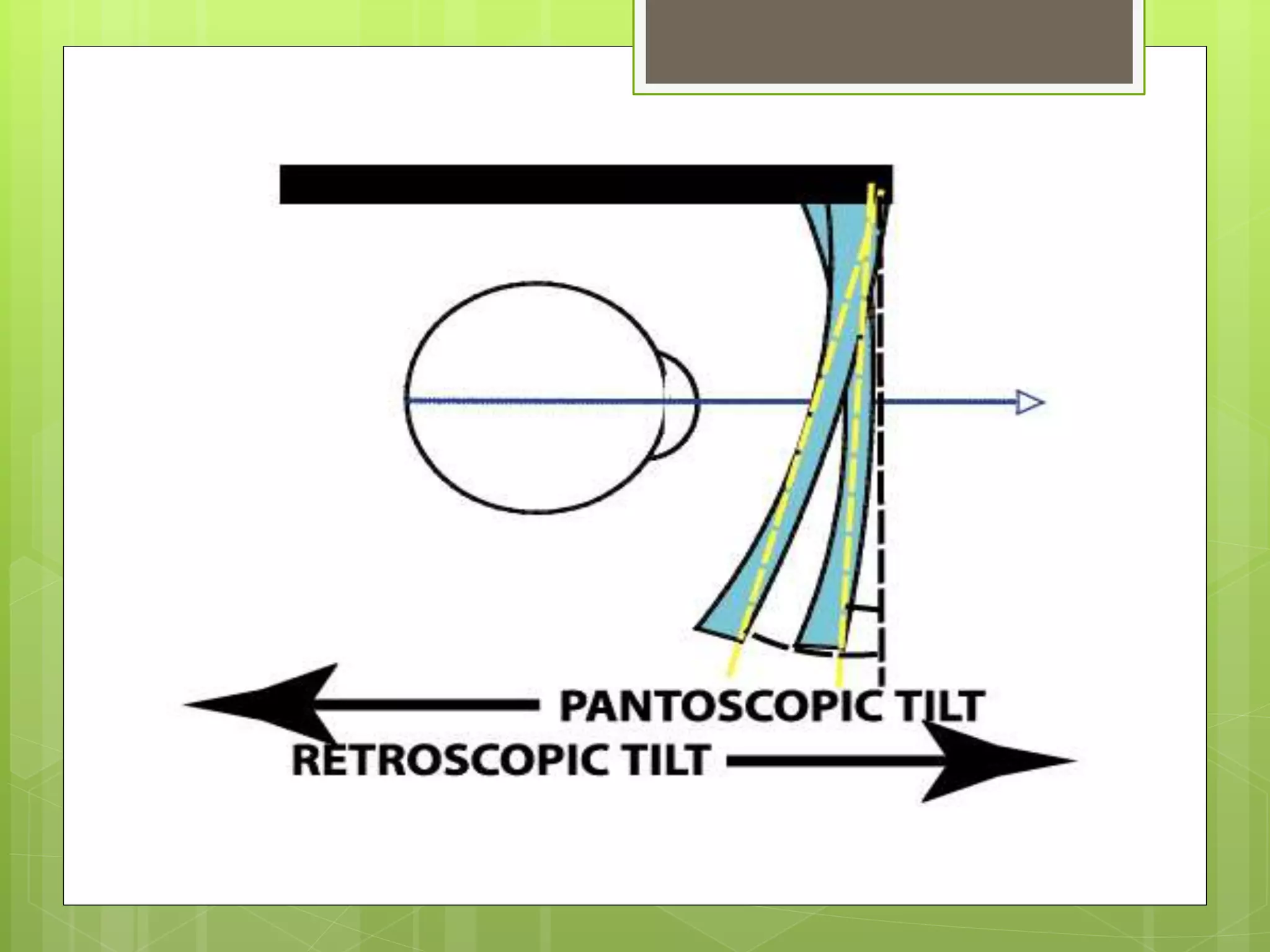 Pantoscopic tilt PPT