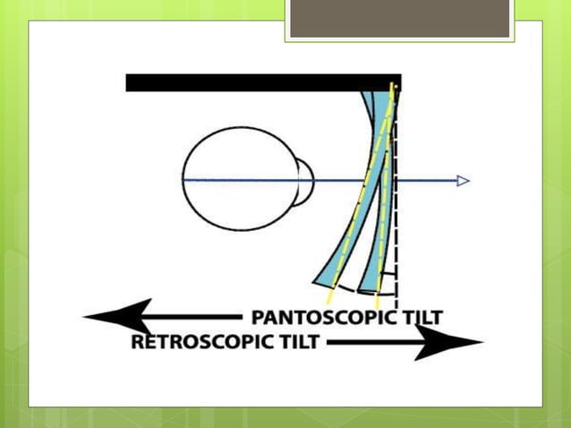 Pantoscopic tilt | PPTX | Eye and Vision Conditions | Diseases and ...