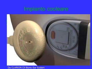 Impianto cocleare
è un orecchio artificiale elettronico che sostituisce la coclea
patologica inviando direttamente al nervo acustico i rumori e
il linguaggio
Da CLARION CII Bionic Ear System
 