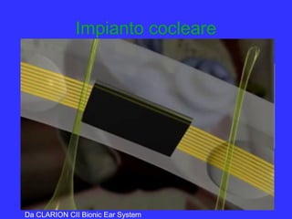 Impianto cocleare
è un orecchio artificiale elettronico che sostituisce la coclea
patologica inviando direttamente al nervo acustico i rumori e
il linguaggio
Da CLARION CII Bionic Ear System
 