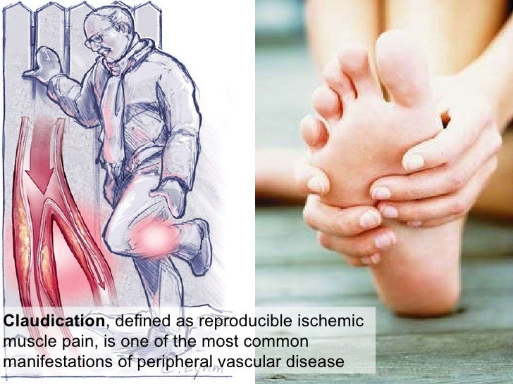 Peripheral arterial occlusive disease