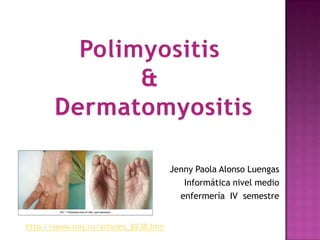 Polimyositis & Dermatomyositis Jenny Paola Alonso Luengas Informática nivel medio  enfermería  IV  semestre  http://www.rmj.ru/articles_6238.htm 