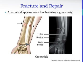 Copyright © John Wiley & Sons, Inc. All rights reserved.
Fracture and Repair
 Anatomical appearance – like breaking a green twig
Greenstick
 