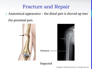 Copyright © John Wiley & Sons, Inc. All rights reserved.
Fracture and Repair
 Anatomical appearance – the distal part is shoved up into
the proximal part.
Impacted
 