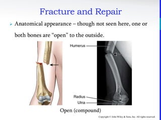 Copyright © John Wiley & Sons, Inc. All rights reserved.
Fracture and Repair
 Anatomical appearance – though not seen here, one or
both bones are “open” to the outside.
Open (compound)
 