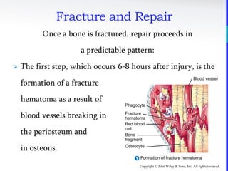 Copyright © John Wiley & Sons, Inc. All rights reserved.
Once a bone is fractured, repair proceeds in
a predictable pattern:
 The first step, which occurs 6-8 hours after injury, is the
formation of a fracture
hematoma as a result of
blood vessels breaking in
the periosteum and
in osteons.
Fracture and Repair
 