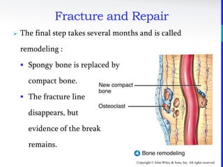 Copyright © John Wiley & Sons, Inc. All rights reserved.
Fracture and Repair
 The final step takes several months and is called
remodeling :
 Spongy bone is replaced by
compact bone.
 The fracture line
disappears, but
evidence of the break
remains.
 
